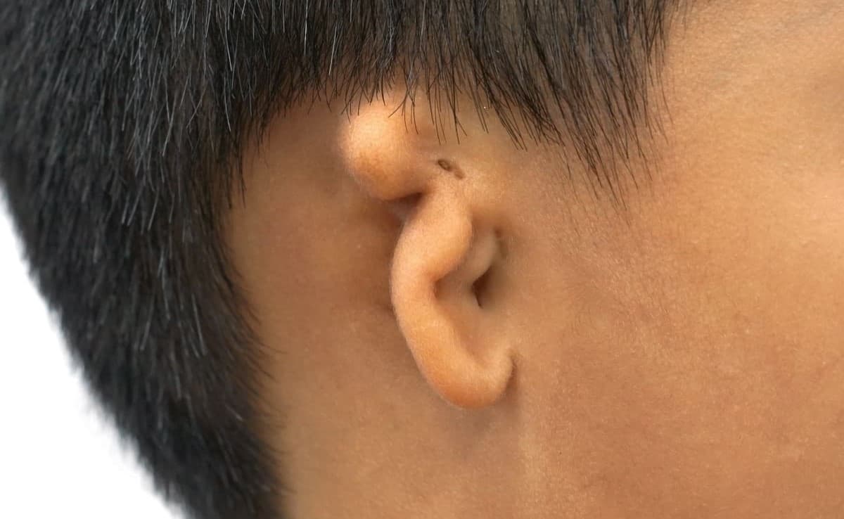 小耳症