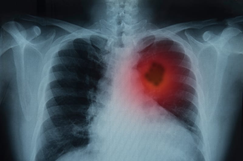 Lung cancer