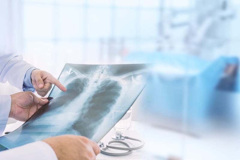 Lung nodule