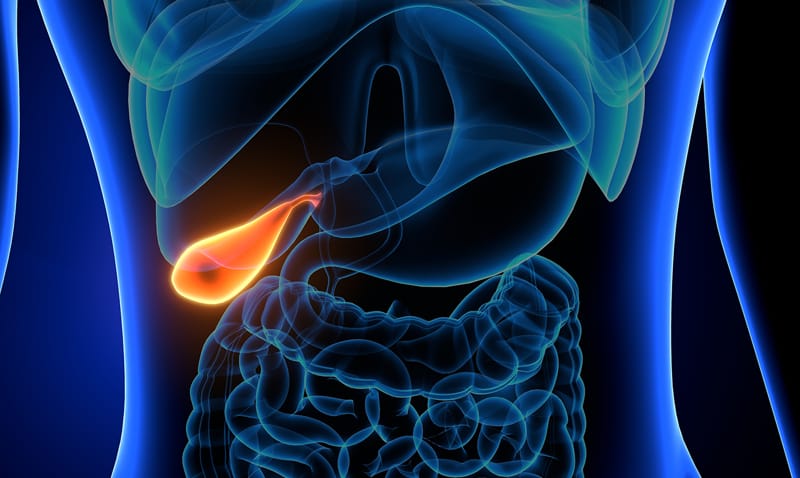 Gallstones