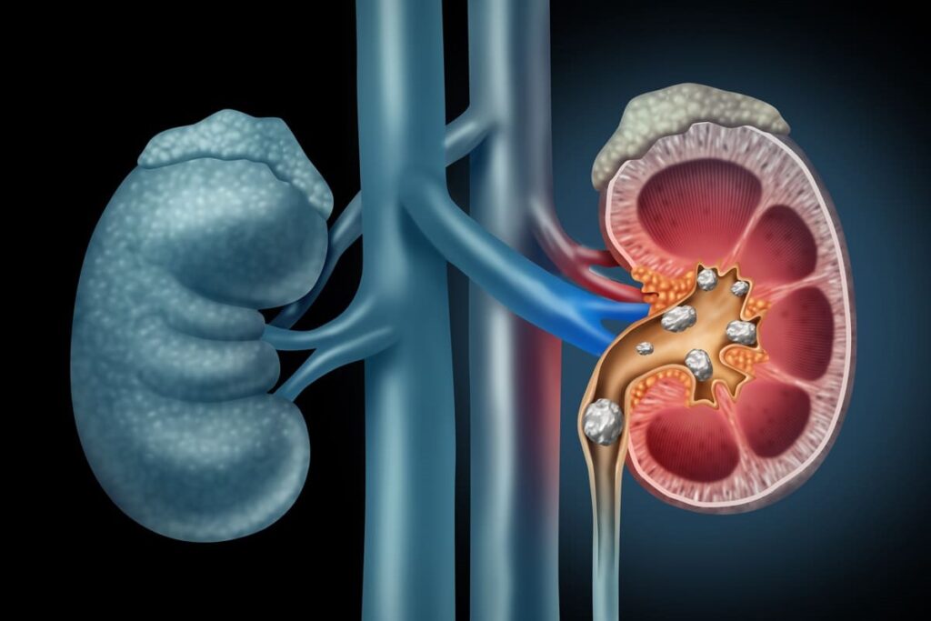 Kidney stone